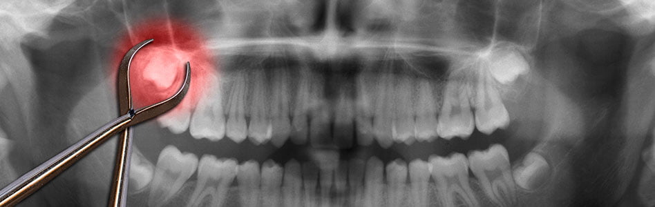 The surprising connection between wisdom teeth and long-term health