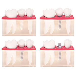 Dental implants queen creek AZ