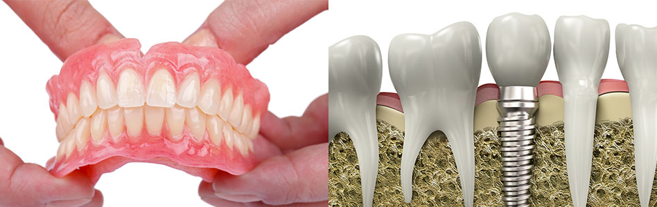 Dentures vs implants