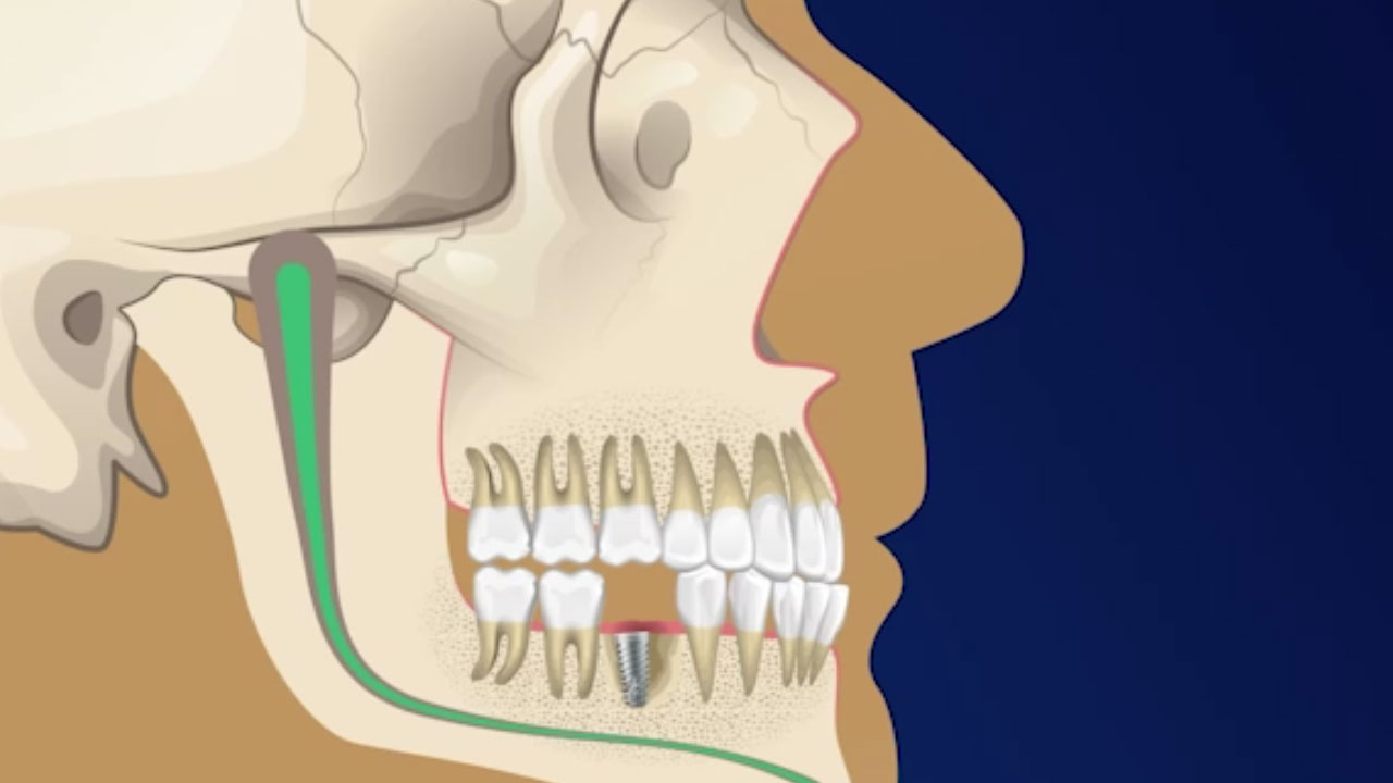 Dental Implant Surgery