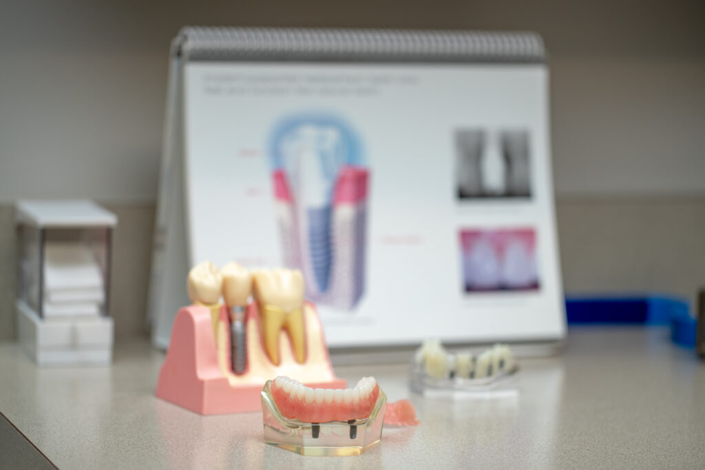 models and diagrams of dental implants