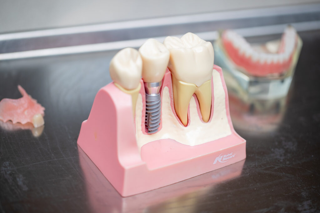 model of dental implant