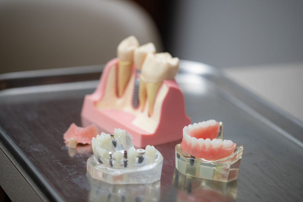 models of teeth and implants