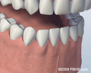 graphic showing a healed mouth