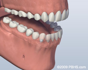 graphic showing a mouth missing lower teeth with dentures in place