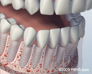 graphic showing implants placed