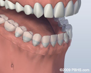 graphic showing bottom dentures placed