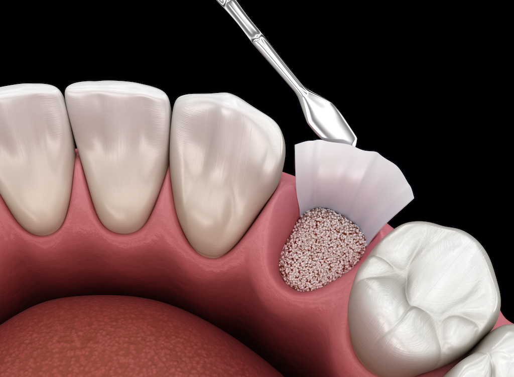 graphic showing the back of a tooth requiring bone grafting