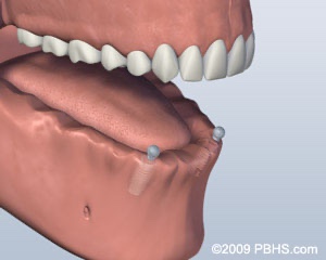 graphic showing all missing lower teeth with implants placed