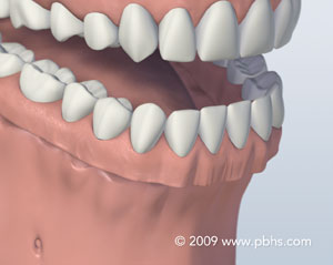 graphic of dentures