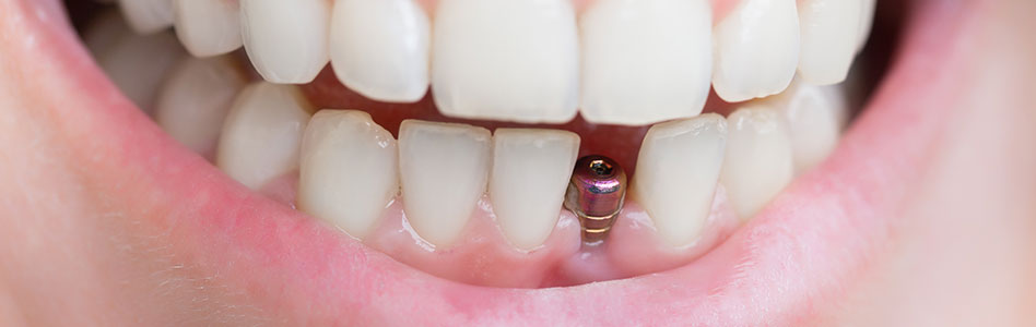 photo of dental implant in a mouth