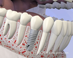 graphic of dental implant