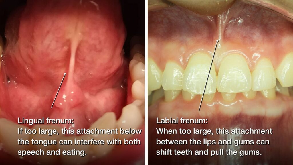 lingual frenum and labial frenum photos