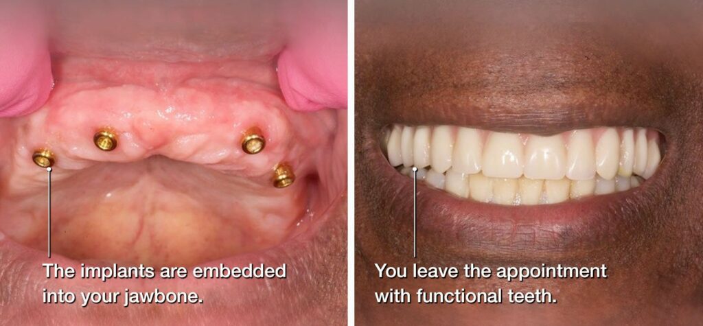 photos of implants embedded in a jawbone and a photo of functional teeth